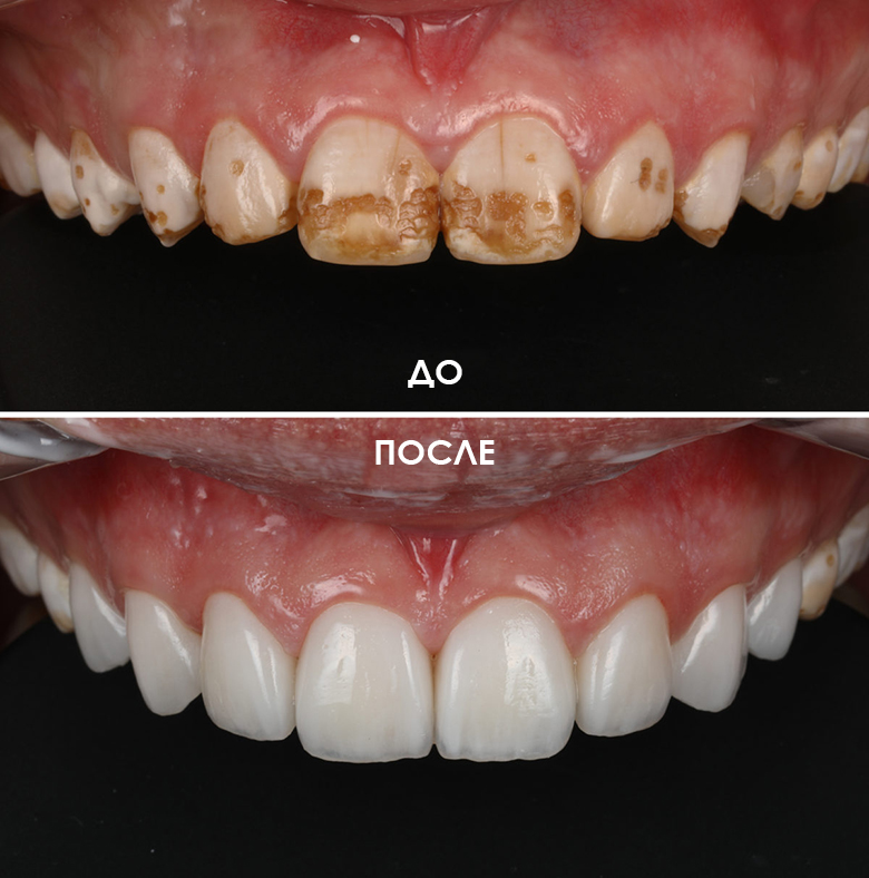 Результат лечения флюороза передней группы зубов