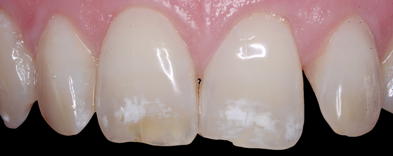 Флюороз на зубах взрослого
