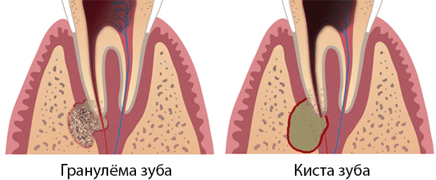Отличие гранулемы зуба от кисты