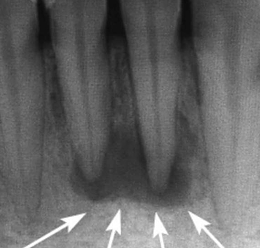 Гранулема зуба на прицельном снимке