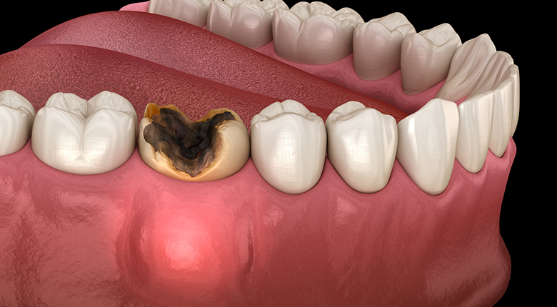 При флюсе под зубом образуется шишка, которая болит