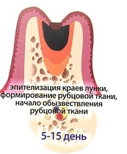 Третий этап восстановления десны после удаления зуба