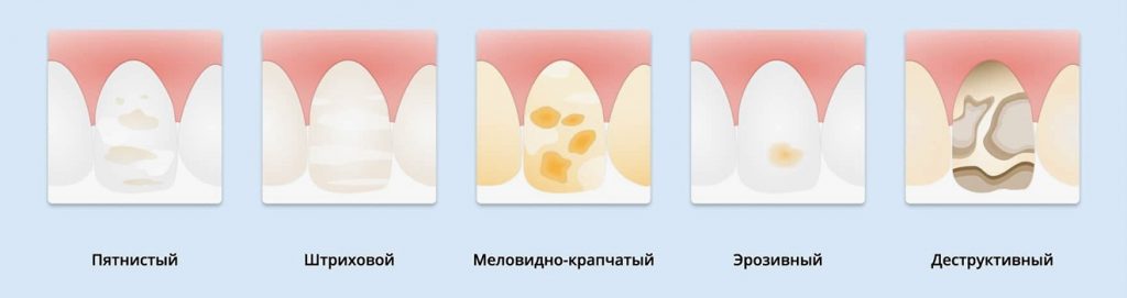 Стадии флюороза