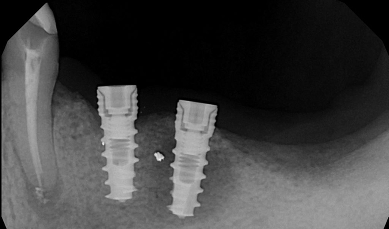 Рентген-снимок зуба в периимплантитом