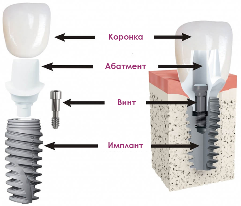 Из каких частей состоит искусственный зуб