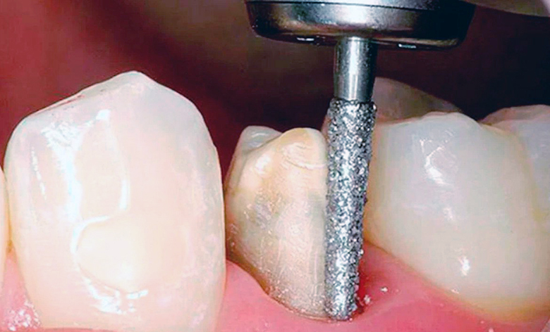 Препарирование зуба в придесневой зоне