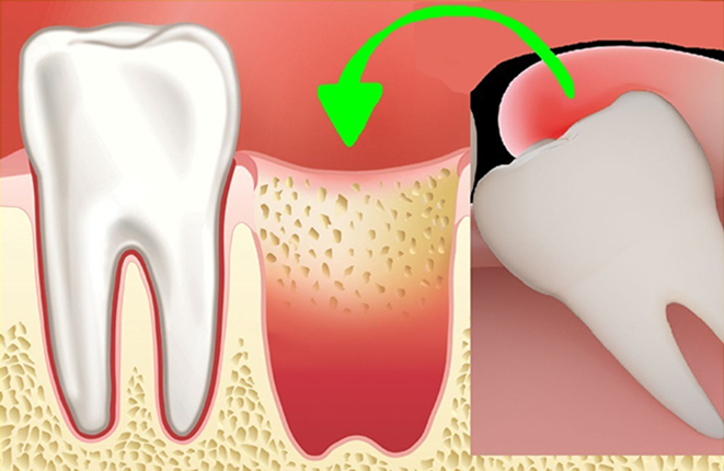 Как проходит аутотрансплантация зубов