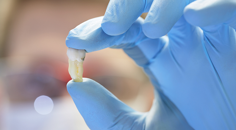 Зуб для аутотрансплантации