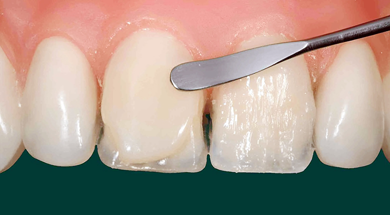 Особенности лечения бокового кариеса на передних зубах