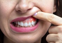 Гингивит – первый шаг к потере зубов?