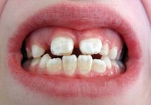 Флюороз – что это за пятна на зубах?