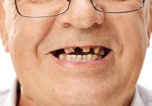Адентия и имплантация зубов