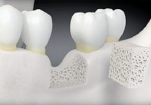Атрофия костной ткани зубов