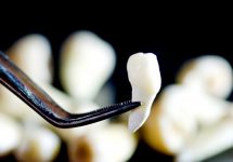 Можно ли пересадить зуб? Всё об аутотрансплантации