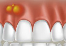 Периапикальный абсцесс зуба